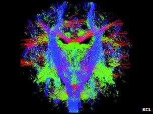 2013英国:英科学家绘制胎儿脑神经"动态路径图"[1]2