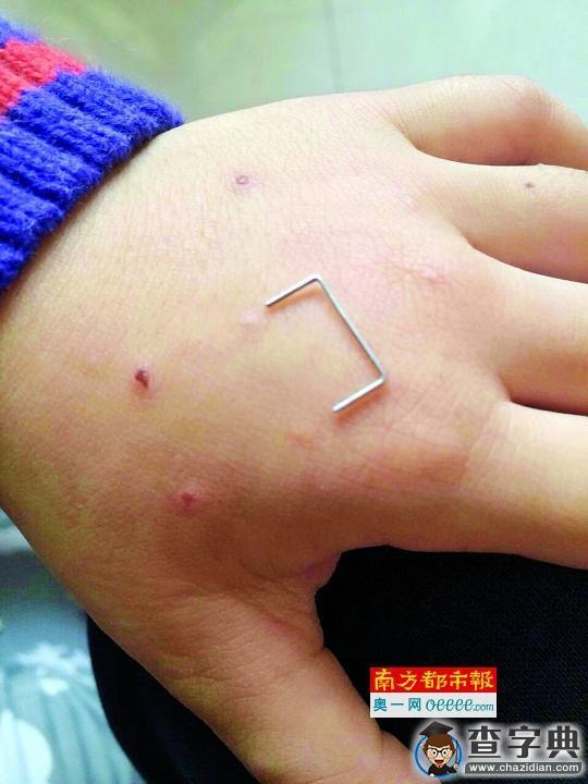 广州四岁男童手背疑被老师用订书针扎伤1